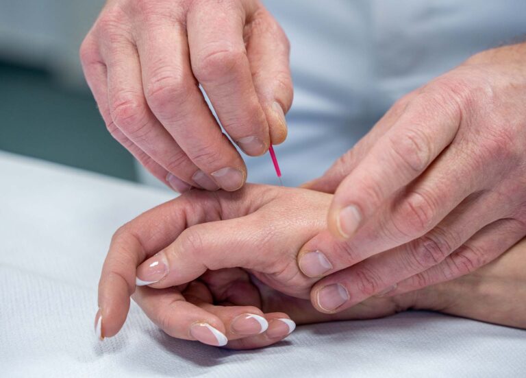 Akupunktur, Nadel, Hand